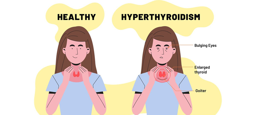 Gyms in Thane | Hyperthyroidism | Thaneweb Thane Mumbai